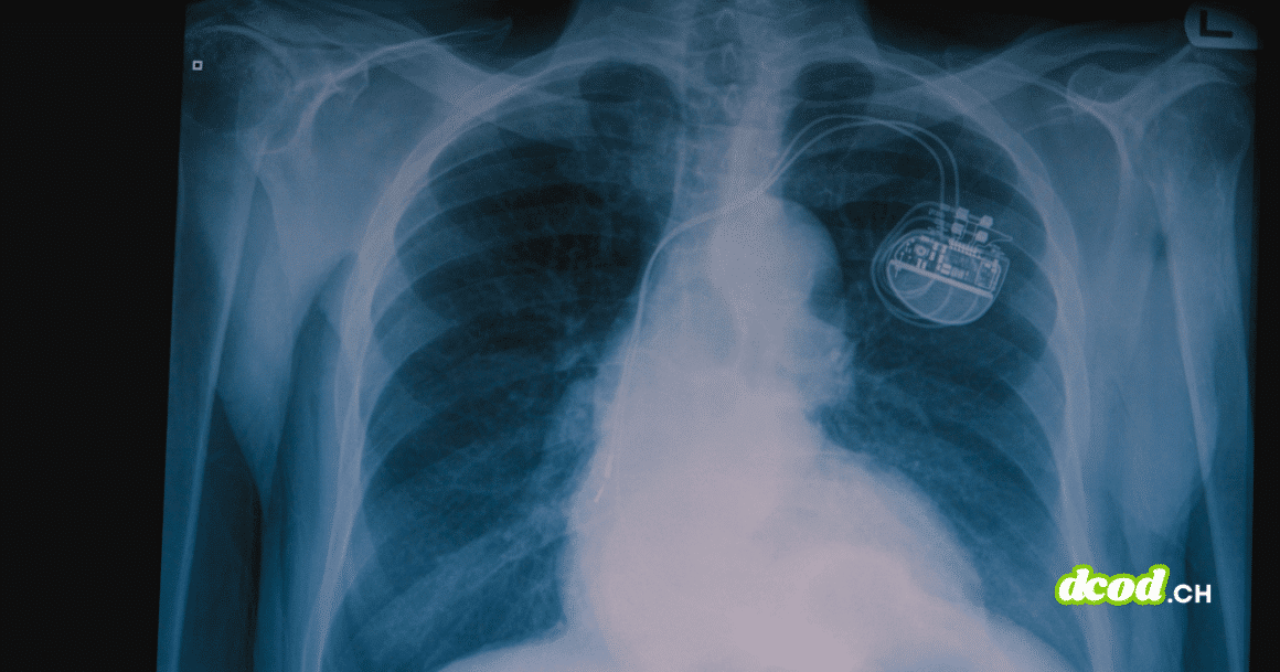Radiographie thoracique montrant un stimulateur cardiaque implanté, illustrant l'intégration d'une puce miniature pour renforcer la santé et la sécurité des patients face aux futures attaques quantiques.
