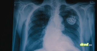 Radiographie thoracique montrant un stimulateur cardiaque implanté, illustrant l'intégration d'une puce miniature pour renforcer la santé et la sécurité des patients face aux futures attaques quantiques.