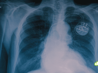 Radiographie thoracique montrant un stimulateur cardiaque implanté, illustrant l'intégration d'une puce miniature pour renforcer la santé et la sécurité des patients face aux futures attaques quantiques.