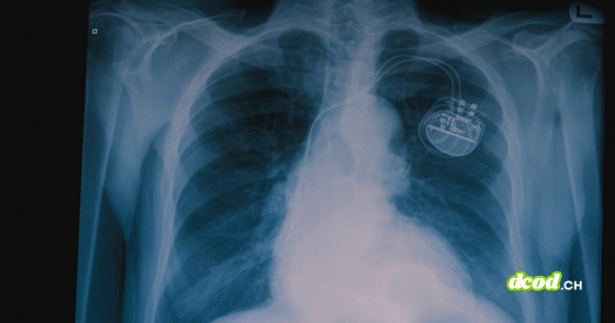 Radiographie thoracique montrant un stimulateur cardiaque implanté, illustrant l'intégration d'une puce miniature pour renforcer la santé et la sécurité des patients face aux futures attaques quantiques.