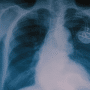 Radiographie thoracique montrant un stimulateur cardiaque implanté, illustrant l'intégration d'une puce miniature pour renforcer la santé et la sécurité des patients face aux futures attaques quantiques.