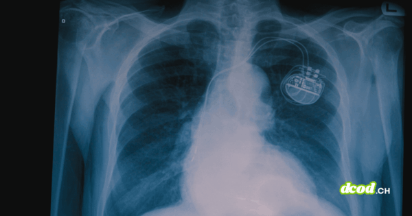 Radiographie thoracique montrant un stimulateur cardiaque implanté, illustrant l'intégration d'une puce miniature pour renforcer la santé et la sécurité des patients face aux futures attaques quantiques.